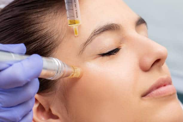Microneedling service in Tampa Florida