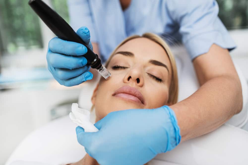 microneedling in tampa